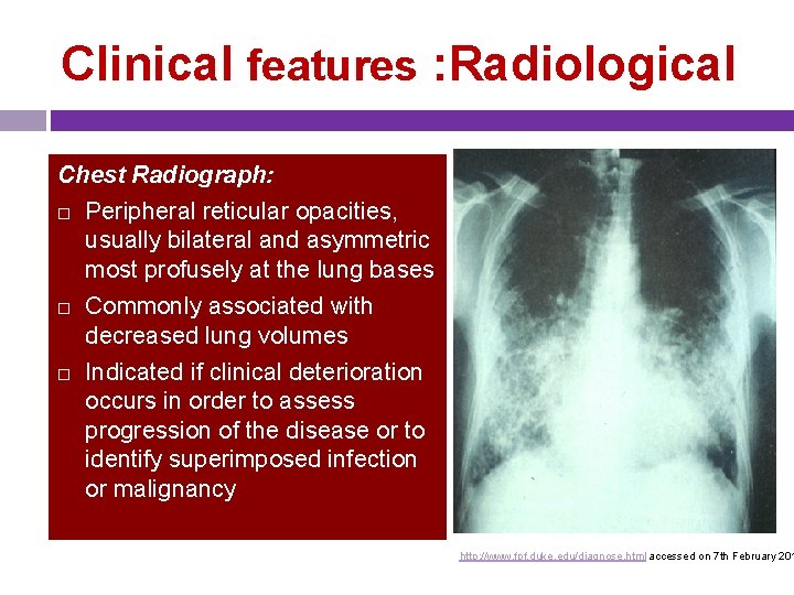 Clinical features : Radiological Chest Radiograph: Peripheral reticular opacities, usually bilateral and asymmetric most