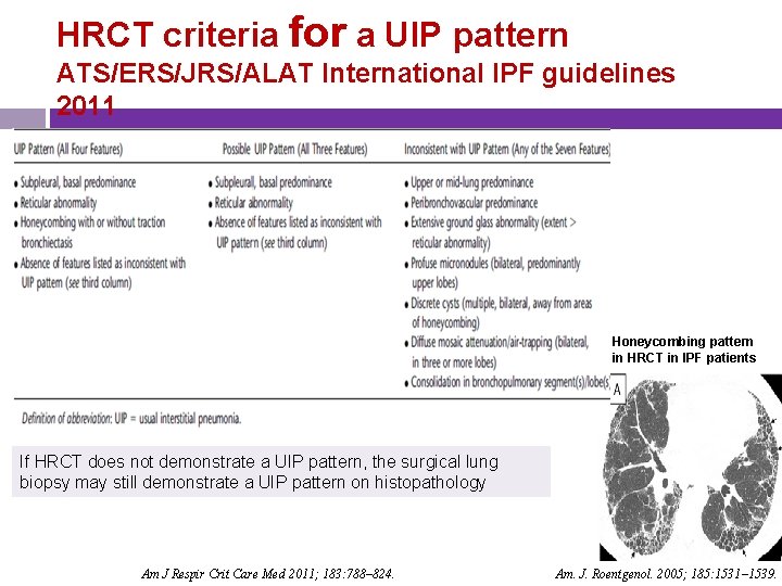 HRCT criteria for a UIP pattern ATS/ERS/JRS/ALAT International IPF guidelines 2011 Honeycombing pattern in