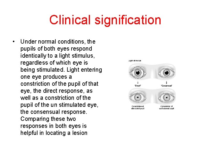 Clinical signification • Under normal conditions, the pupils of both eyes respond identically to