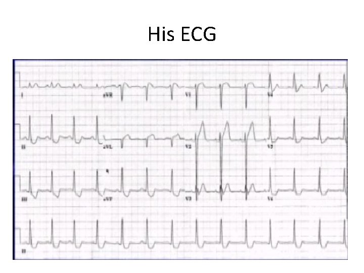 His ECG 