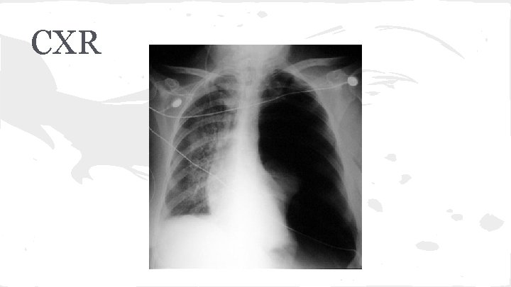 CXR 