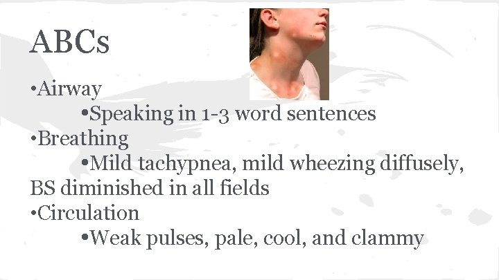 ABCs • Airway Speaking in 1 -3 word sentences • Breathing Mild tachypnea, mild