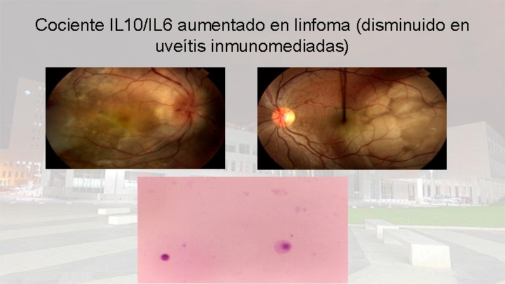 Cociente IL 10/IL 6 aumentado en linfoma (disminuido en uveítis inmunomediadas) 