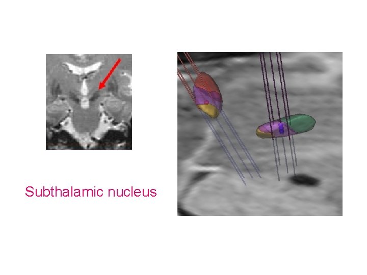 Subthalamic nucleus 