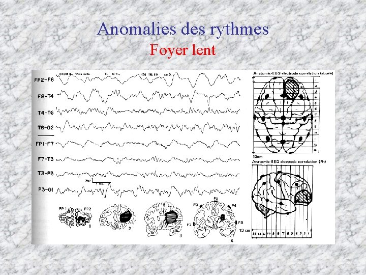 Anomalies des rythmes Foyer lent 