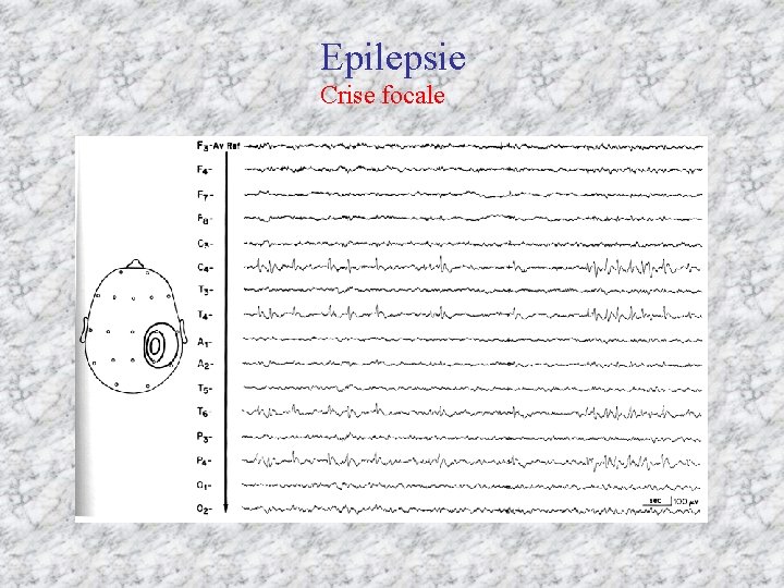 Epilepsie Crise focale 