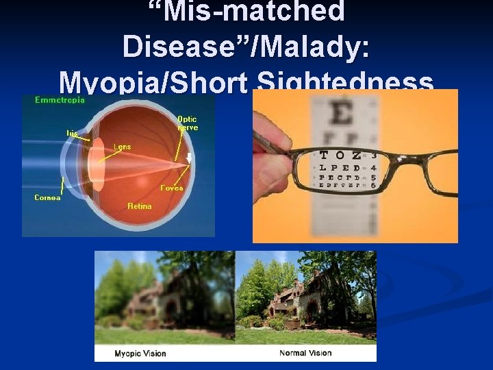 “Mis-matched Disease”/Malady: Myopia/Short Sightedness 