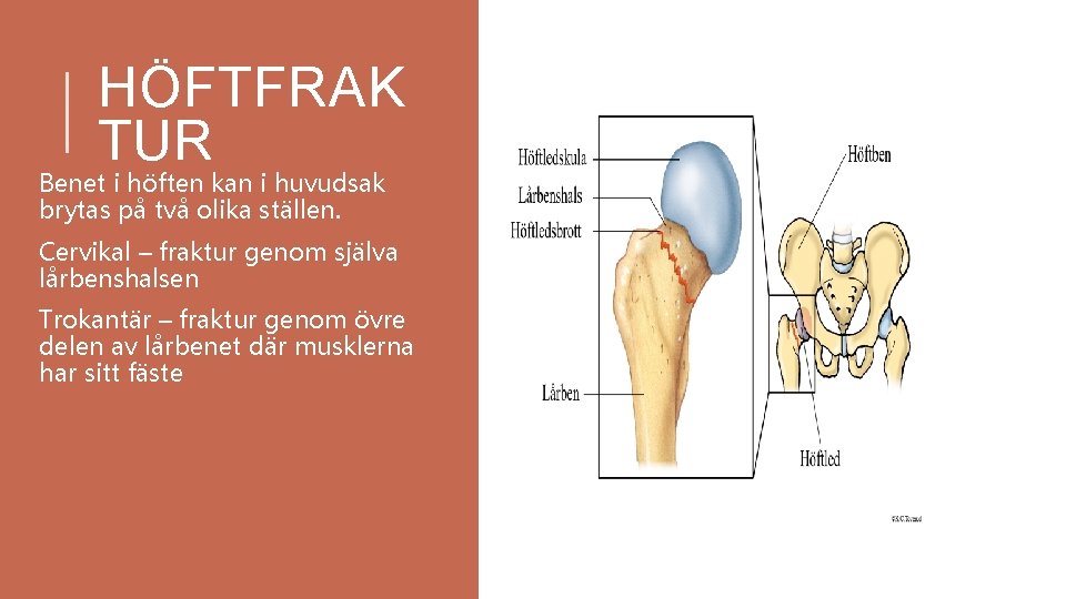 HÖFTFRAK TUR Benet i höften kan i huvudsak brytas på två olika ställen. Cervikal