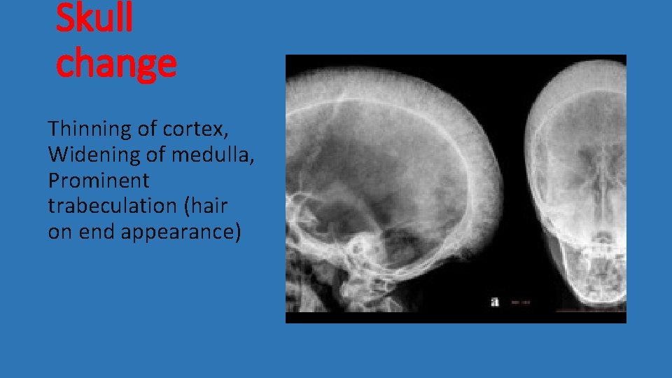 Skull change Thinning of cortex, Widening of medulla, Prominent trabeculation (hair on end appearance)