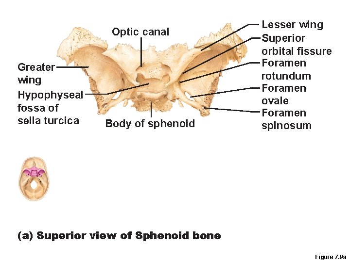 Optic canal Greater wing Hypophyseal fossa of sella turcica Body of sphenoid Lesser wing