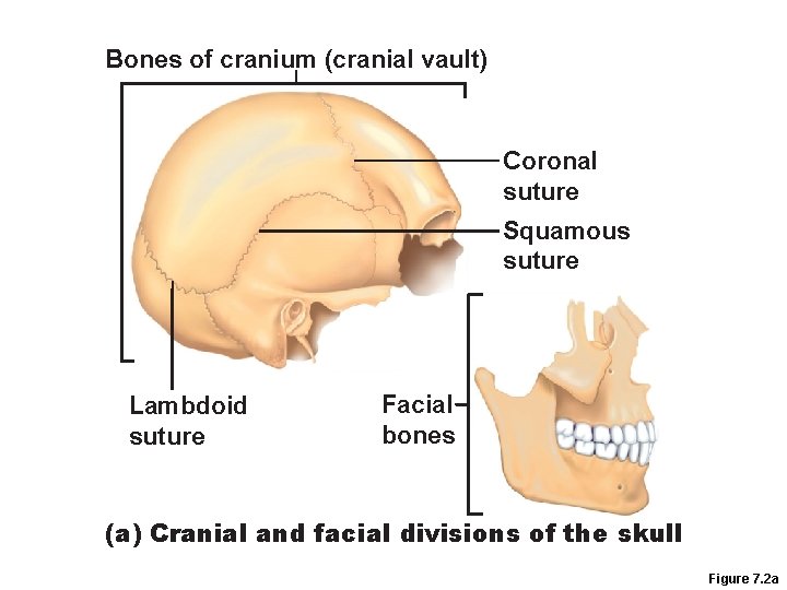 Bones of cranium (cranial vault) Coronal suture Squamous suture Lambdoid suture Facial bones (a)