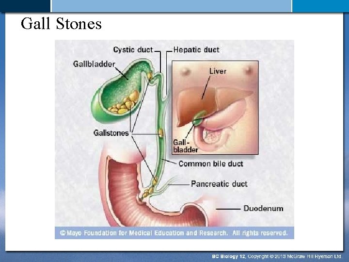 Gall Stones 