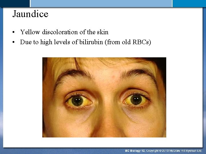 Jaundice • Yellow discoloration of the skin • Due to high levels of bilirubin