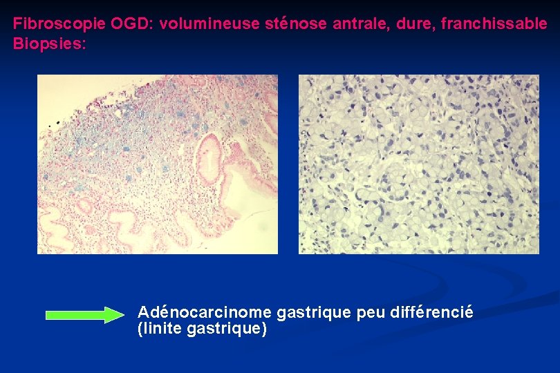 Fibroscopie OGD: volumineuse sténose antrale, dure, franchissable Biopsies: Adénocarcinome gastrique peu différencié (linite gastrique)