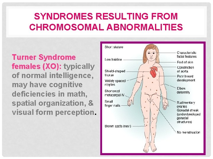 SYNDROMES RESULTING FROM CHROMOSOMAL ABNORMALITIES Turner Syndrome females (XO): (XO typically of normal intelligence,
