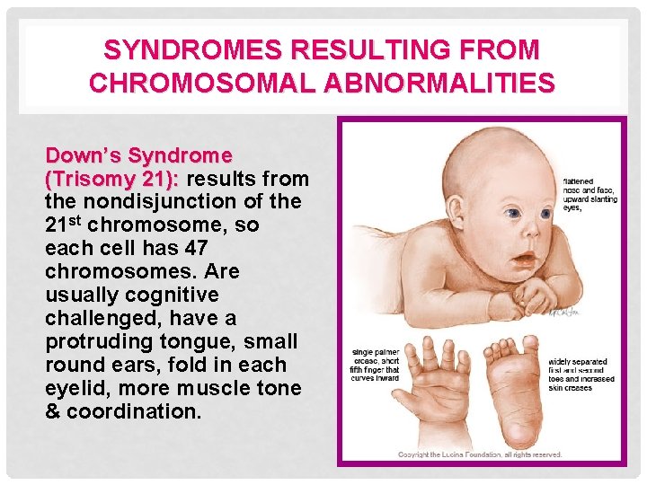 SYNDROMES RESULTING FROM CHROMOSOMAL ABNORMALITIES Down’s Syndrome (Trisomy 21): results from the nondisjunction of