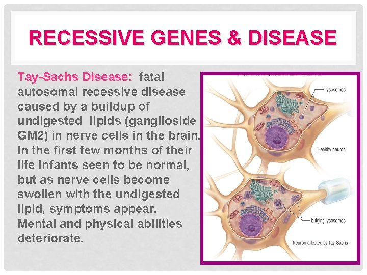 RECESSIVE GENES & DISEASE Tay-Sachs Disease: fatal autosomal recessive disease caused by a buildup