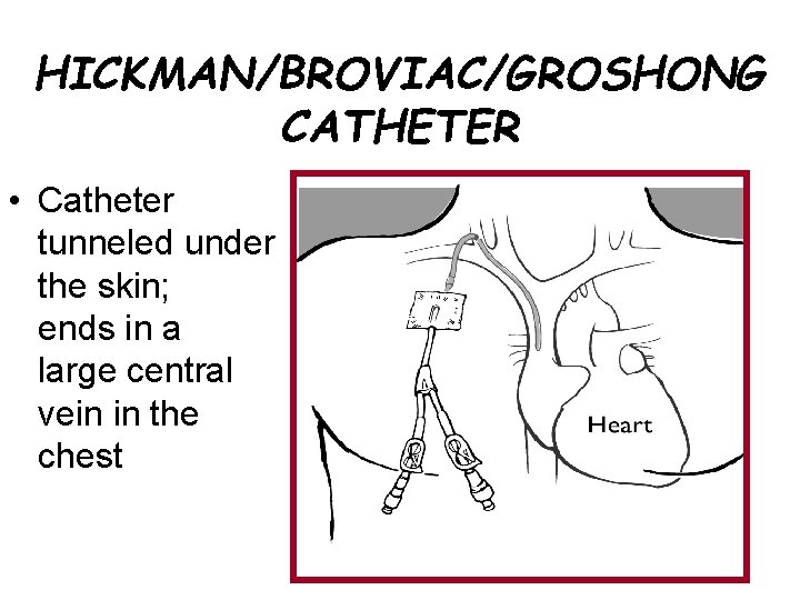 HICKMAN/BROVIAC/GROSHONG CATHETER • Catheter tunneled under the skin; ends in a large central vein