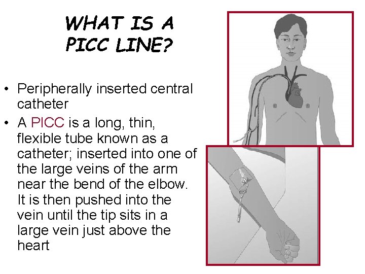 WHAT IS A PICC LINE? • Peripherally inserted central catheter • A PICC is