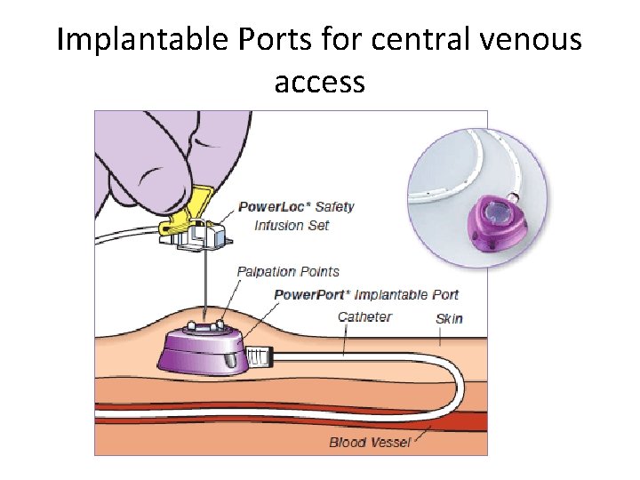 Implantable Ports for central venous access 