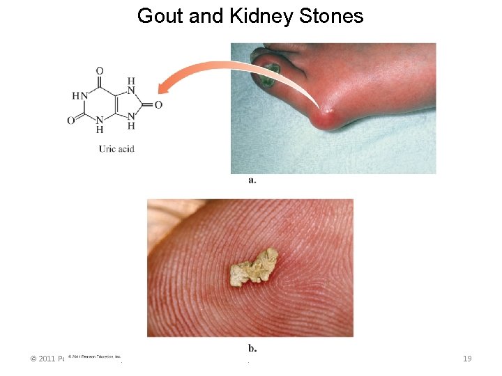 Gout and Kidney Stones © 2011 Pearson Education, Inc. Chapter 7 19 