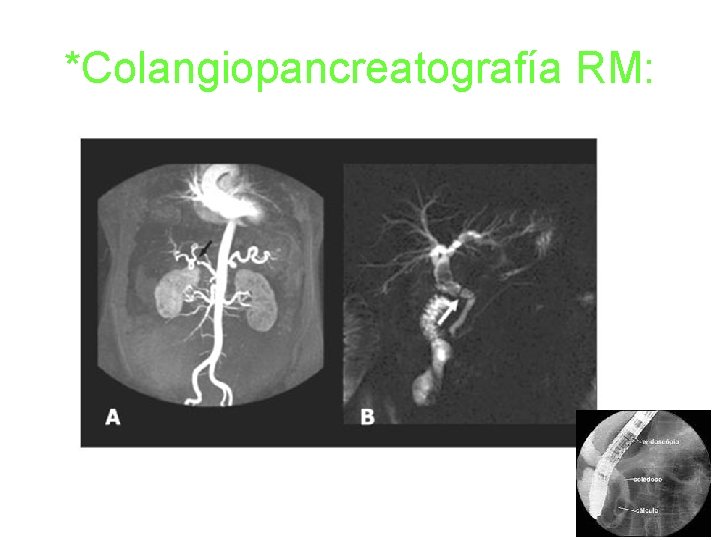 *Colangiopancreatografía RM: 