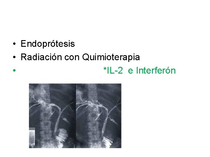  • Endoprótesis • Radiación con Quimioterapia • *IL-2 e Interferón 