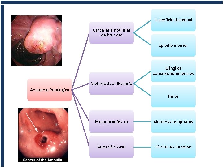 Superficie duodenal Canceres ampulares derivan de: Epitelio interior Gánglios pancreatoduodenales Metastasis a distancia Anatomía