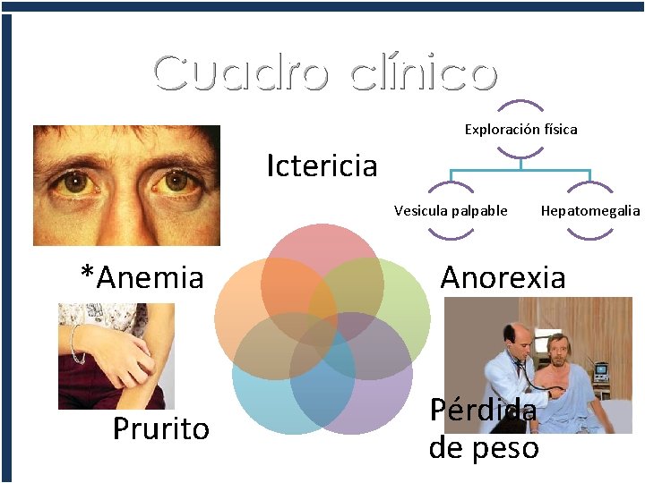 Cuadro clínico Exploración física Ictericia Vesicula palpable *Anemia Prurito Hepatomegalia Anorexia Pérdida de peso