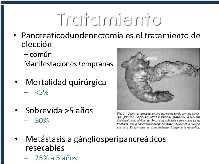 Tratamiento • Pancreaticoduodenectomía es el tratamiento de elección + común Manifestaciones tempranas • Mortalidad