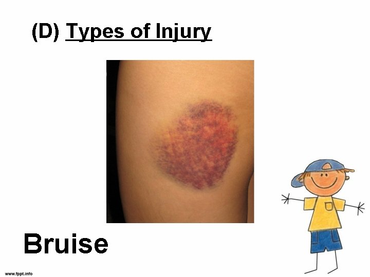 (D) Types of Injury Bruise 