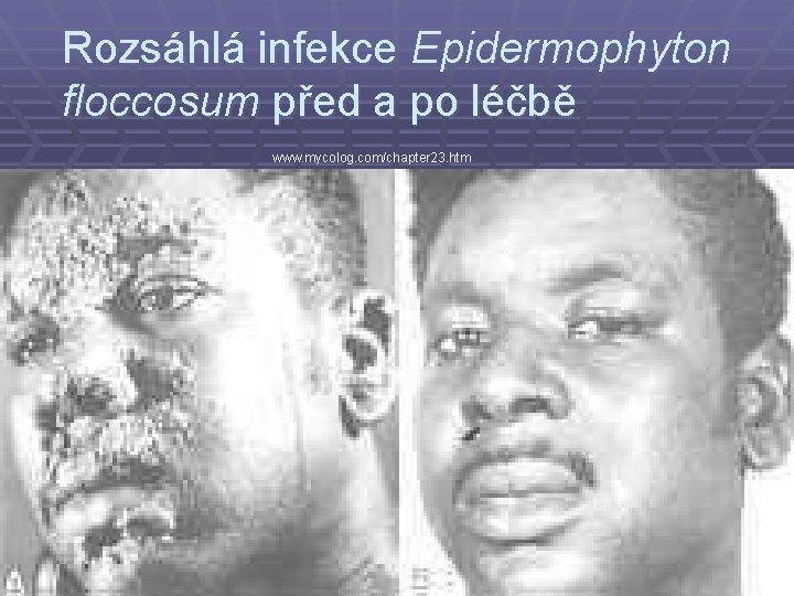 Rozsáhlá infekce Epidermophyton floccosum před a po léčbě www. mycolog. com/chapter 23. htm 