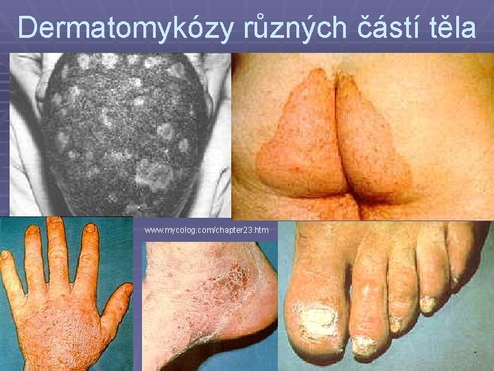 Dermatomykózy různých částí těla www. mycolog. com/chapter 23. htm 