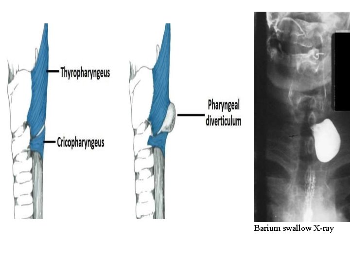 Barium swallow X-ray  Barium swallow X-ray