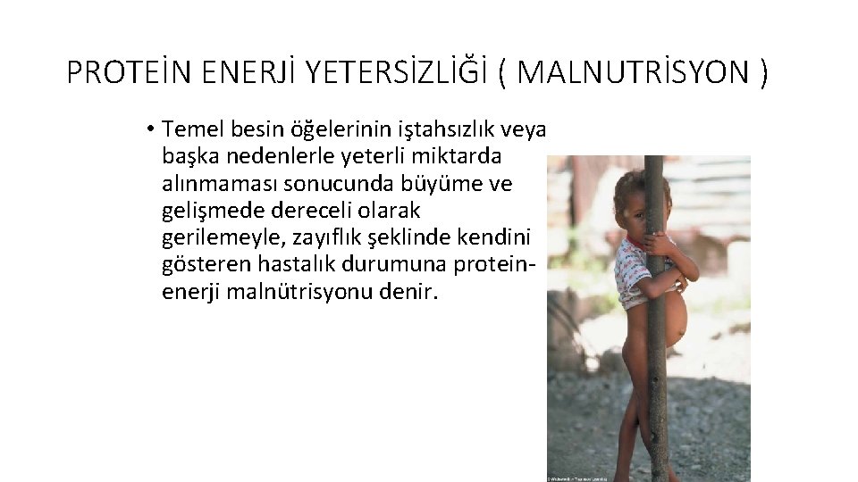 PROTEİN ENERJİ YETERSİZLİĞİ ( MALNUTRİSYON ) • Temel besin öğelerinin iştahsızlık veya başka nedenlerle