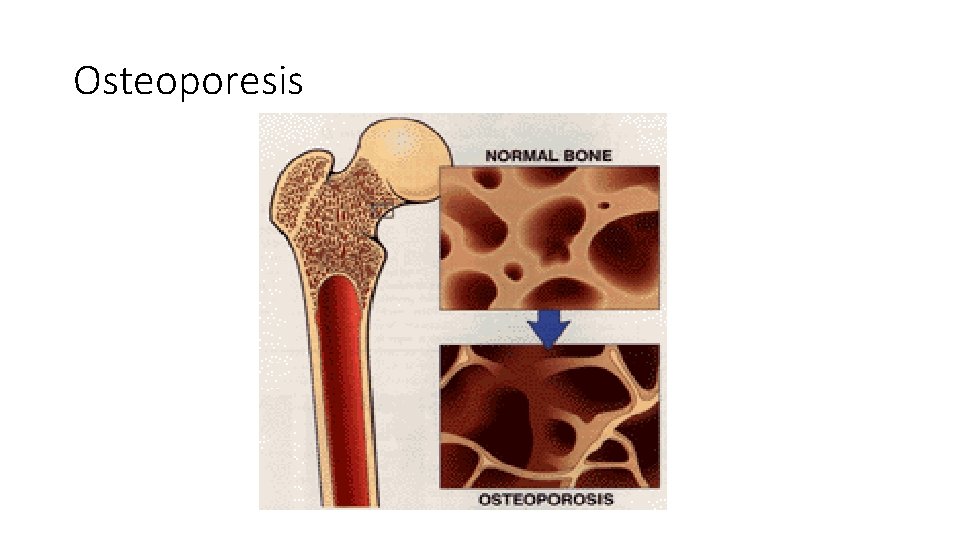 Osteoporesis 