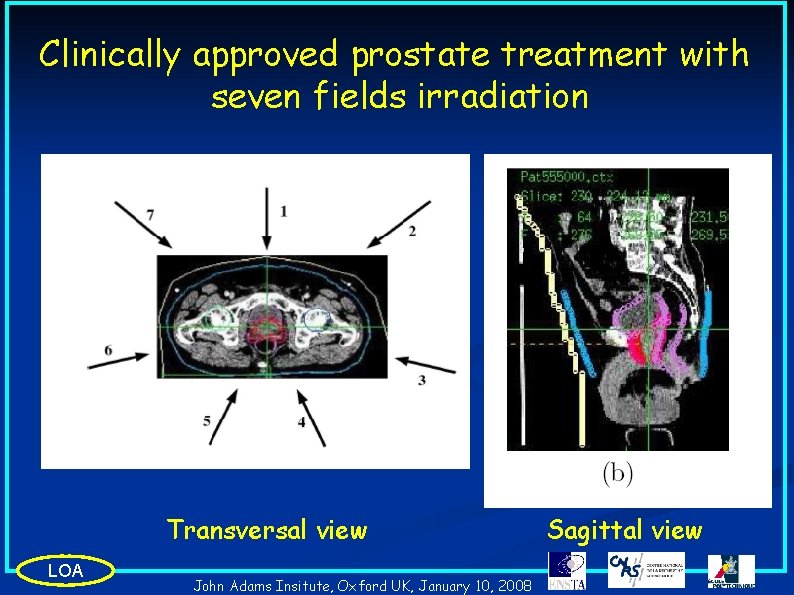 Clinically approved prostate treatment with seven fields irradiation Transversal view LOA John Adams Insitute,