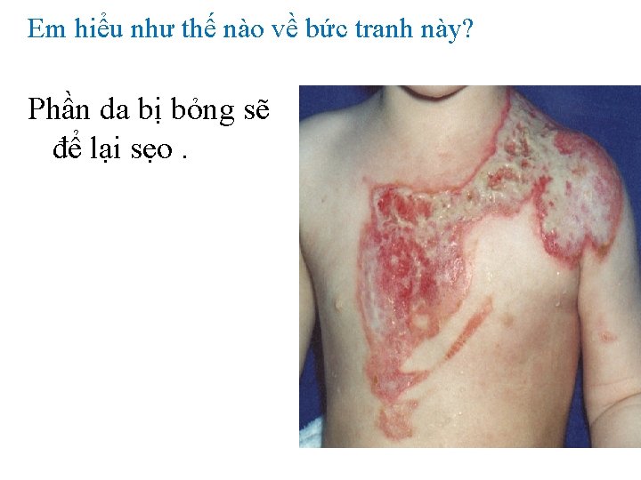 Em hiểu như thế nào về bức tranh này? Phần da bị bỏng sẽ