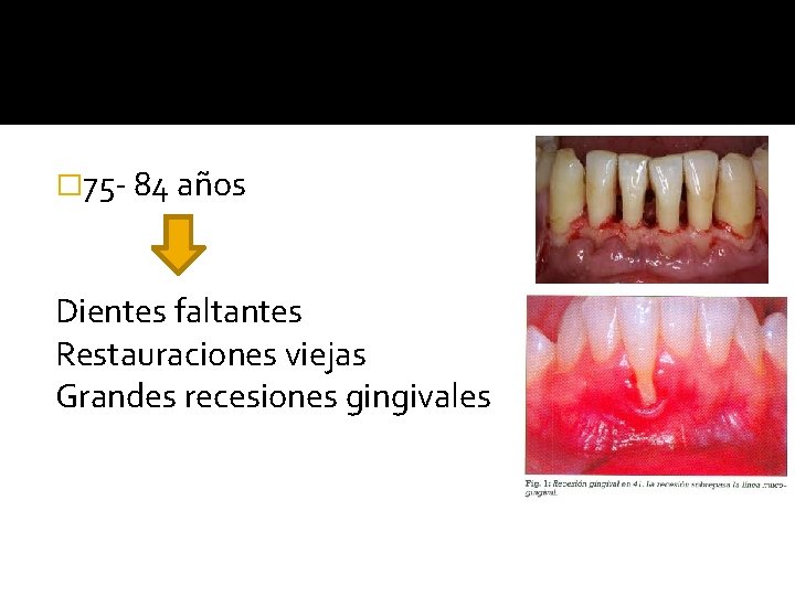 � 75 - 84 años Dientes faltantes Restauraciones viejas Grandes recesiones gingivales 