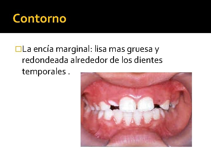 Contorno �La encía marginal: lisa mas gruesa y redondeada alrededor de los dientes temporales.