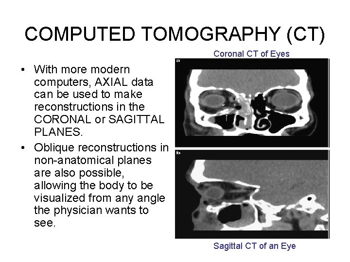 COMPUTED TOMOGRAPHY (CT) Coronal CT of Eyes • With more modern computers, AXIAL data