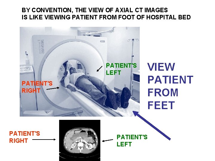 BY CONVENTION, THE VIEW OF AXIAL CT IMAGES IS LIKE VIEWING PATIENT FROM FOOT