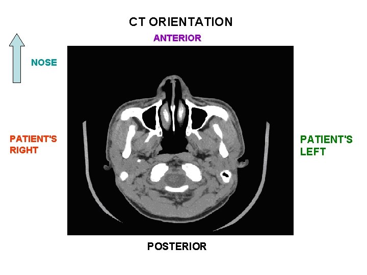 CT ORIENTATION ANTERIOR NOSE PATIENT'S RIGHT PATIENT'S LEFT POSTERIOR 