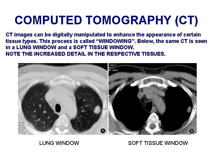COMPUTED TOMOGRAPHY (CT) CT images can be digitally manipulated to enhance the appearance of