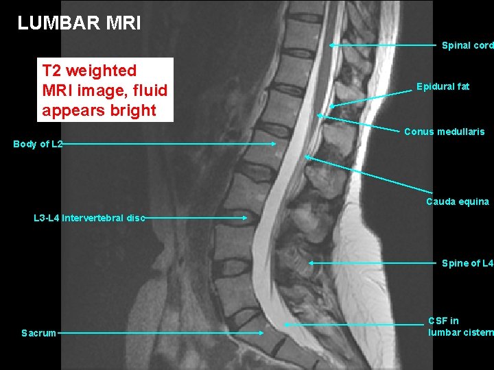 LUMBAR MRI Spinal cord T 2 weighted MRI image, fluid appears bright Epidural fat