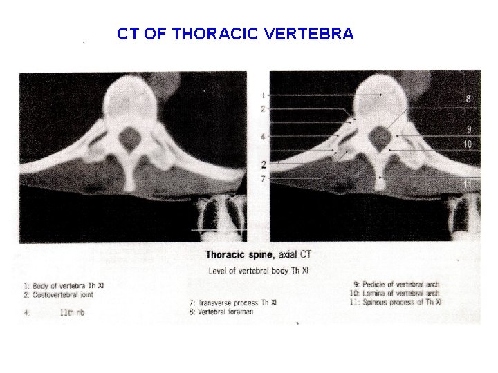 CT OF THORACIC VERTEBRA 