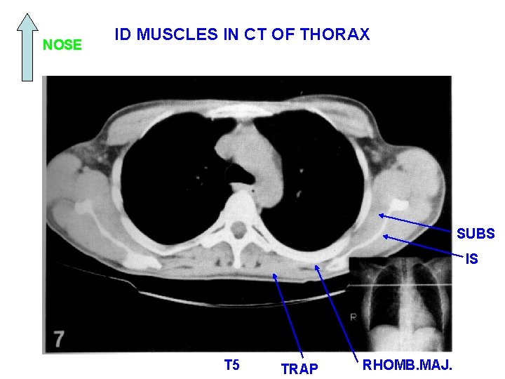 NOSE ID MUSCLES IN CT OF THORAX SUBS IS T 5 TRAP RHOMB. MAJ.
