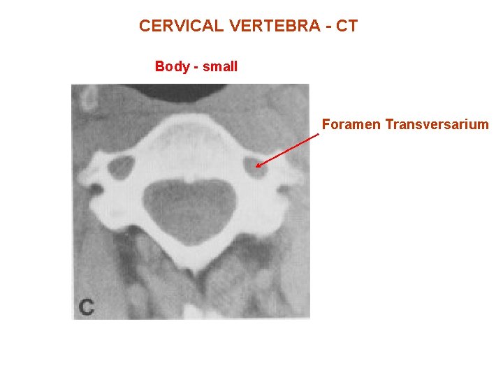 CERVICAL VERTEBRA - CT Body - small Foramen Transversarium 