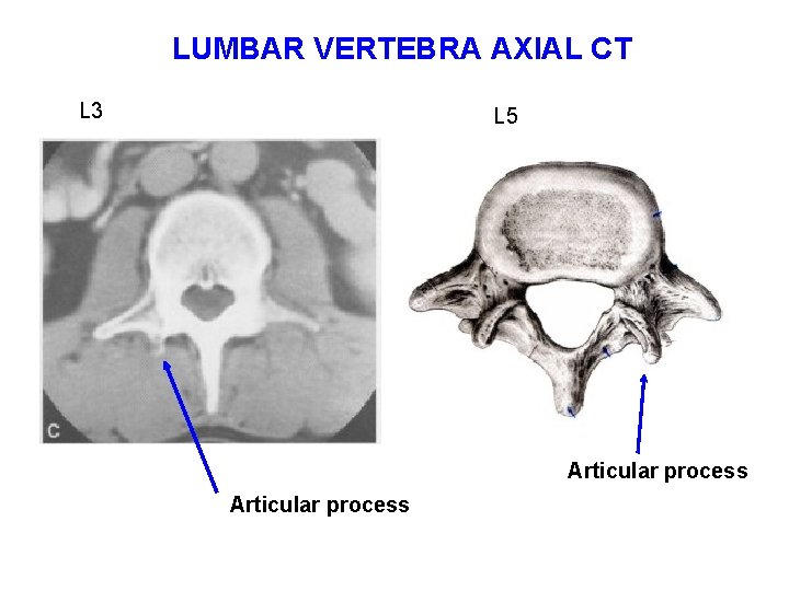 LUMBAR VERTEBRA AXIAL CT L 3 L 5 Articular process 