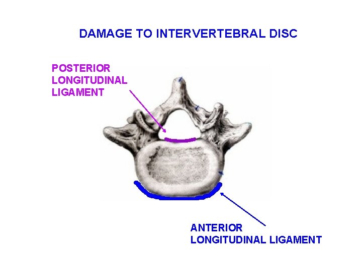 DAMAGE TO INTERVERTEBRAL DISC POSTERIOR LONGITUDINAL LIGAMENT ANTERIOR LONGITUDINAL LIGAMENT 